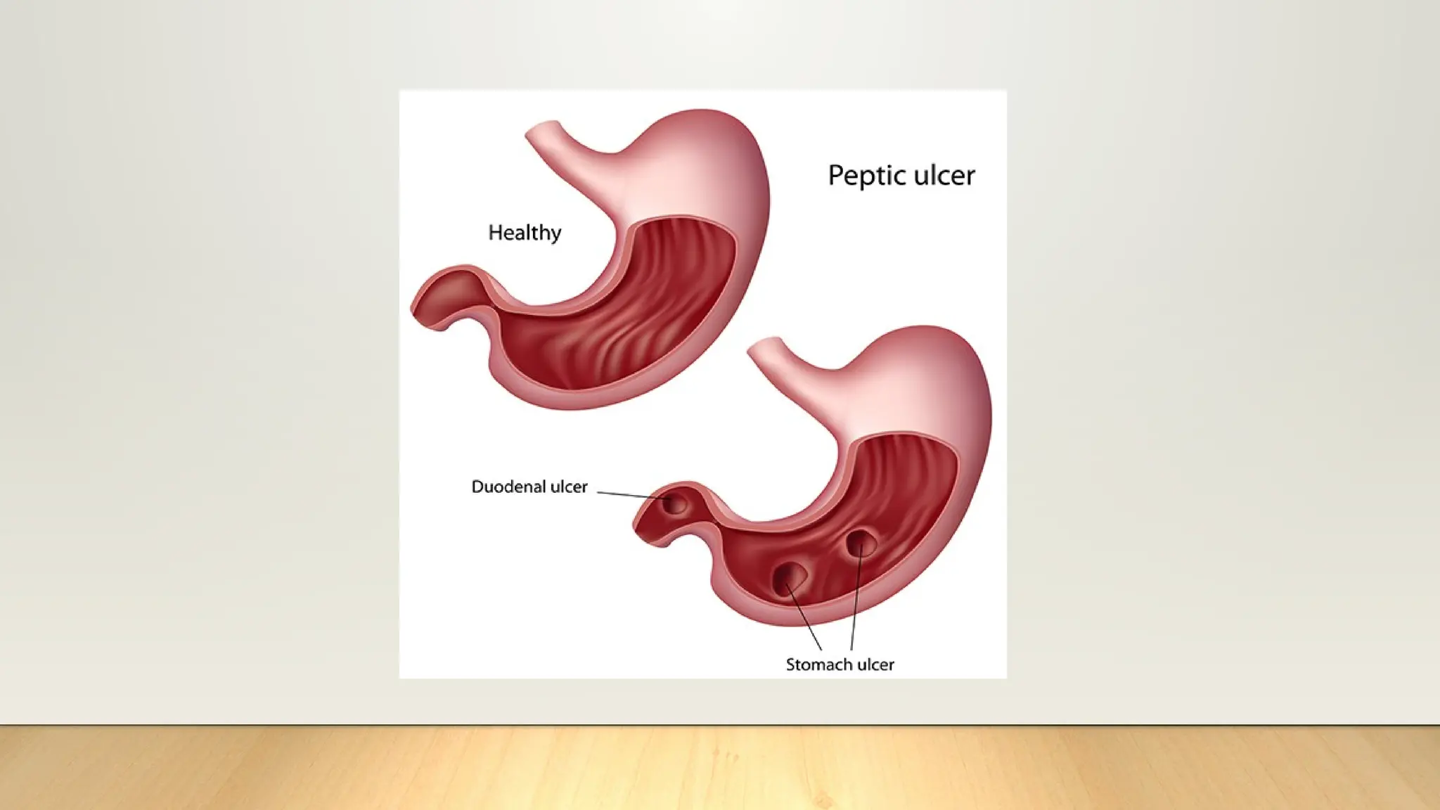 Antiulcer agents (Agents used to treat peptic ulcers) | PPTX