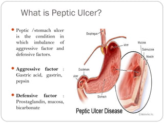 What is Peptic Ulcer?
 Peptic /stomach ulcer
  is the condition in
  which imbalance of
  aggressive factor and
  defensive factors.

 Aggressive    factor :
  Gastric acid, gastrin,
  pepsin

 Defensive    factor :
  Prostaglandin, mucosa,
  bicarbonate
 