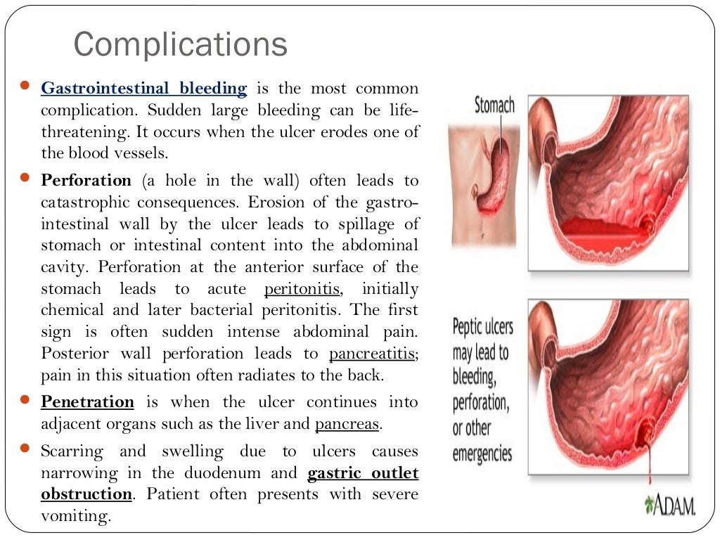 Anti ulcer drugs classification