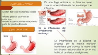 ¿Qué ES LA Úlcera PÉPTICA?
Es una llaga abierta o un área en carne
viva en el revestimiento del estómago o el
intestino.
¿Qué ES LA GASTRITIS?
Es la inflamación del
revestimiento del
estómago.
La inflamación de la gastritis se
produce por la misma infección
bacteriana que provoca la mayoría de
las úlceras estomacales o por el uso
habitual de ciertos analgésicos.
Existen dos tipos de úlceras pépticas
•Úlcera gástrica: ocurre en el
estómago
•Úlcera duodenal: ocurre en la primera
parte del intestino Delgado
 