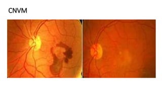 Anti VEGF in Ophthalmology | PPTX
