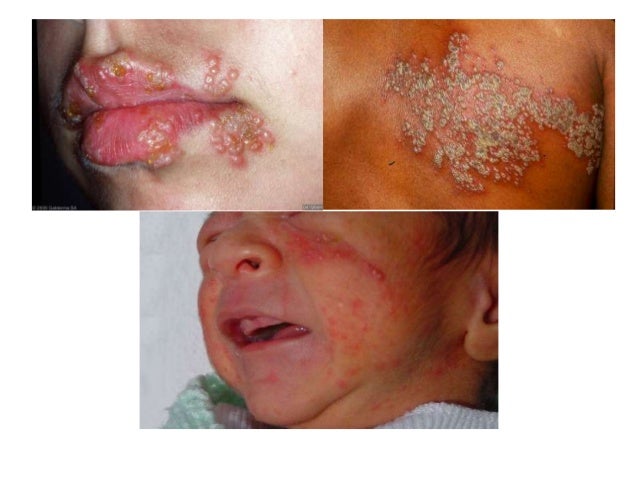 Partnersuche mit herpes genitalis