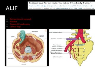 Anterior / lateral lumbar interbody Fusion | PDF