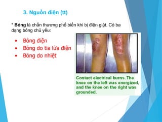 * Bỏng là chấn thương phổ biến khi bị điện giật. Có ba
dạng bỏng chủ yếu:
• Bỏng điện
• Bỏng do tia lửa điện
• Bỏng do nhiệt
3. Nguồn điện (tt)
 