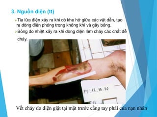 Tia lửa điện xảy ra khi có khe hở giữa các vật dẫn, tạo
ra dòng điện phóng trong không khí và gây bỏng.
Bỏng do nhiệt xảy ra khi dòng điện làm cháy các chất dễ
cháy.
Vết cháy do điện giật tại mặt trước cẳng tay phải của nạn nhân
3. Nguồn điện (tt)
 