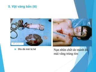  Đĩa đá mài bị bể Nạn nhân chết do mảnh đá
mài văng trúng tim
5. Vật văng bắn (tt)
 