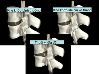 Khe khớp bình thường Khe khớp khi cúi về trước
Thoát vị đĩa đệm
 