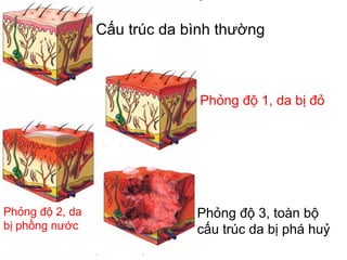 Cấu trúc da bình thường
Phỏng độ 1, da bị đỏ
Phỏng độ 3, toàn bộ
cấu trúc da bị phá huỷ
Phỏng độ 2, da
bị phồng nước
 