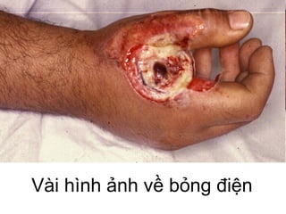 Vài hình ảnh về bỏng điện
 