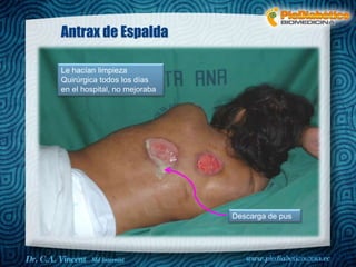 Dr. VINCENT, M.D 
Antrax de Espalda 
Descarga de pus 
Le hacían limpieza 
Quirúrgica todos los días 
en el hospital, no mejoraba 
 