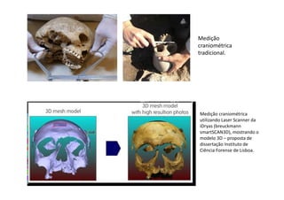 Medição
craniométrica
tradicional.
Medição craniométrica
utilizando Laser Scanner da
iDryas (breuckmann
smartSCAN3D), mostrando o
modelo 3D – proposta de
dissertação Instituto de
Ciência Forense de Lisboa.
 