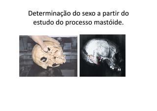 Determinação do sexo a partir do
estudo do processo mastóide.
 