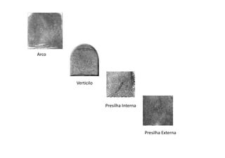 Arco
Verticilo
Presilha Interna
Presilha Externa
 