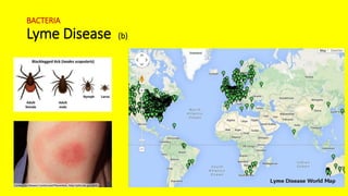 BACTERIA
Lyme Disease (b)
 