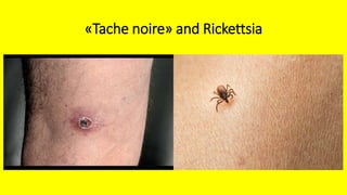«Tache noire» and Rickettsia
 