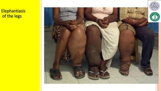Elephantiasis
of the legs
 
