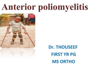 Anterior poliomyelitis
Dr. THOUSEEF
FIRST YR PG
MS ORTHO
 