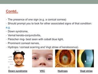Contd..
• The presence of one sign (e.g. a conical cornea)
• Should prompt you to look for other associated signs of that condition:
e.g.
• Down syndrome,
• Vernal kerato-conjunctivitis,
• Fleischer ring- best seen with cobalt blue light,
• Prominent corneal nerves,
• Hydrops / corneal scarring and Vogt striae of keratoconus).
VKC Hydrops Vogt striae
Down syndrome
 