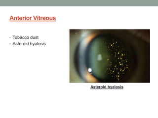 Anterior Vitreous
• Tobacco dust
• Asteroid hyalosis
Asteroid hyalosis
 