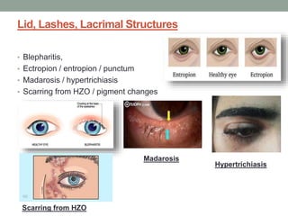 Lid, Lashes, Lacrimal Structures
• Blepharitis,
• Ectropion / entropion / punctum
• Madarosis / hypertrichiasis
• Scarring from HZO / pigment changes
Madarosis
Hypertrichiasis
Scarring from HZO
 