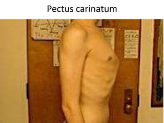 Pectus carinatum 
46 
 