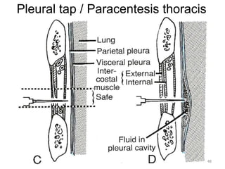 Pleural tap / Paracentesis thoracis 
48 
 