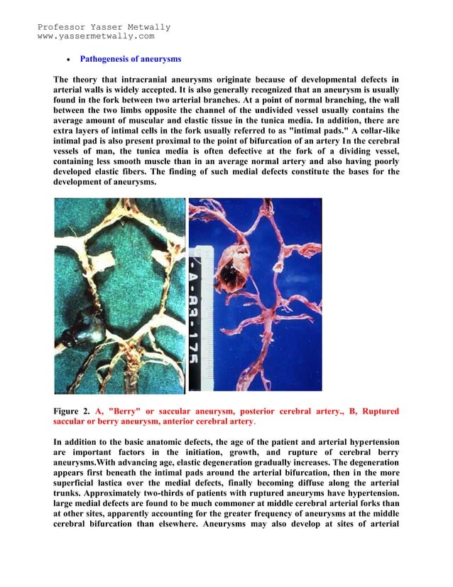 Topic of the month: Radiological pathology of intracranial aneurysms | PDF