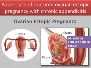 A rare case of ruptured ovarian ectopic
pregnancy with chronic appendicitis
DR. ANU .M
IIIRD YEAR OG PG
SBMCH
 
