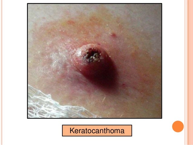 BENIGN TUMORS OF EPITHELIAL ORIGIN