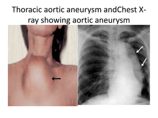 Thoracic aortic aneurysm andChest X-
ray showing aortic aneurysm
 