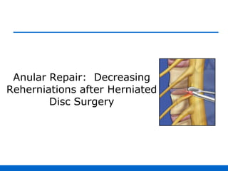 Anular Repair:  Decreasing Reherniations after Herniated Disc Surgery 