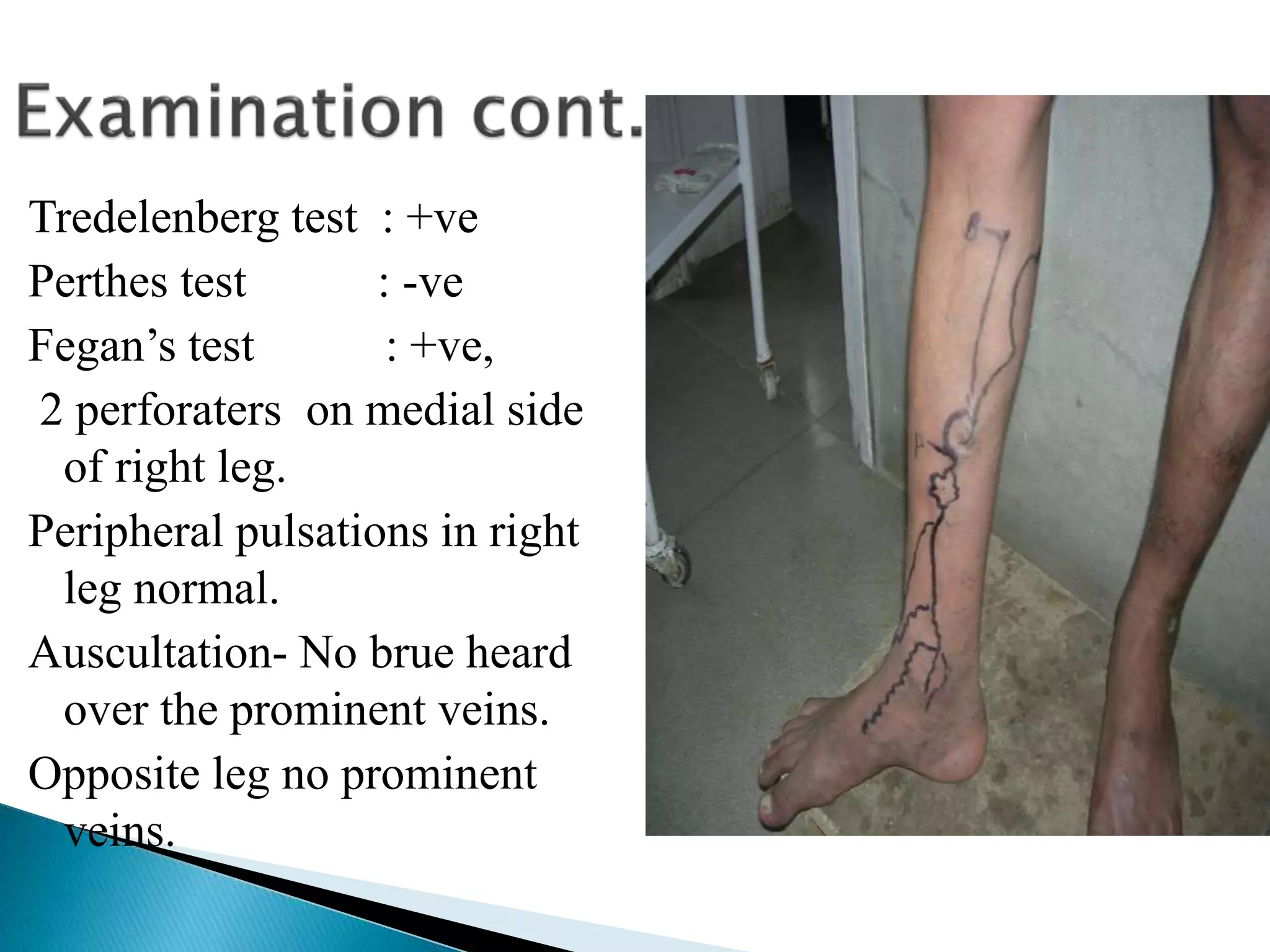 Tredelenberg test : +ve 
Perthes test : -ve 
Fegan’s test : +ve, 
2 perforaters on medial side 
of right leg. 
Peripheral pulsations in right 
leg normal. 
Auscultation- No brue heard 
over the prominent veins. 
Opposite leg no prominent 
veins. 
 