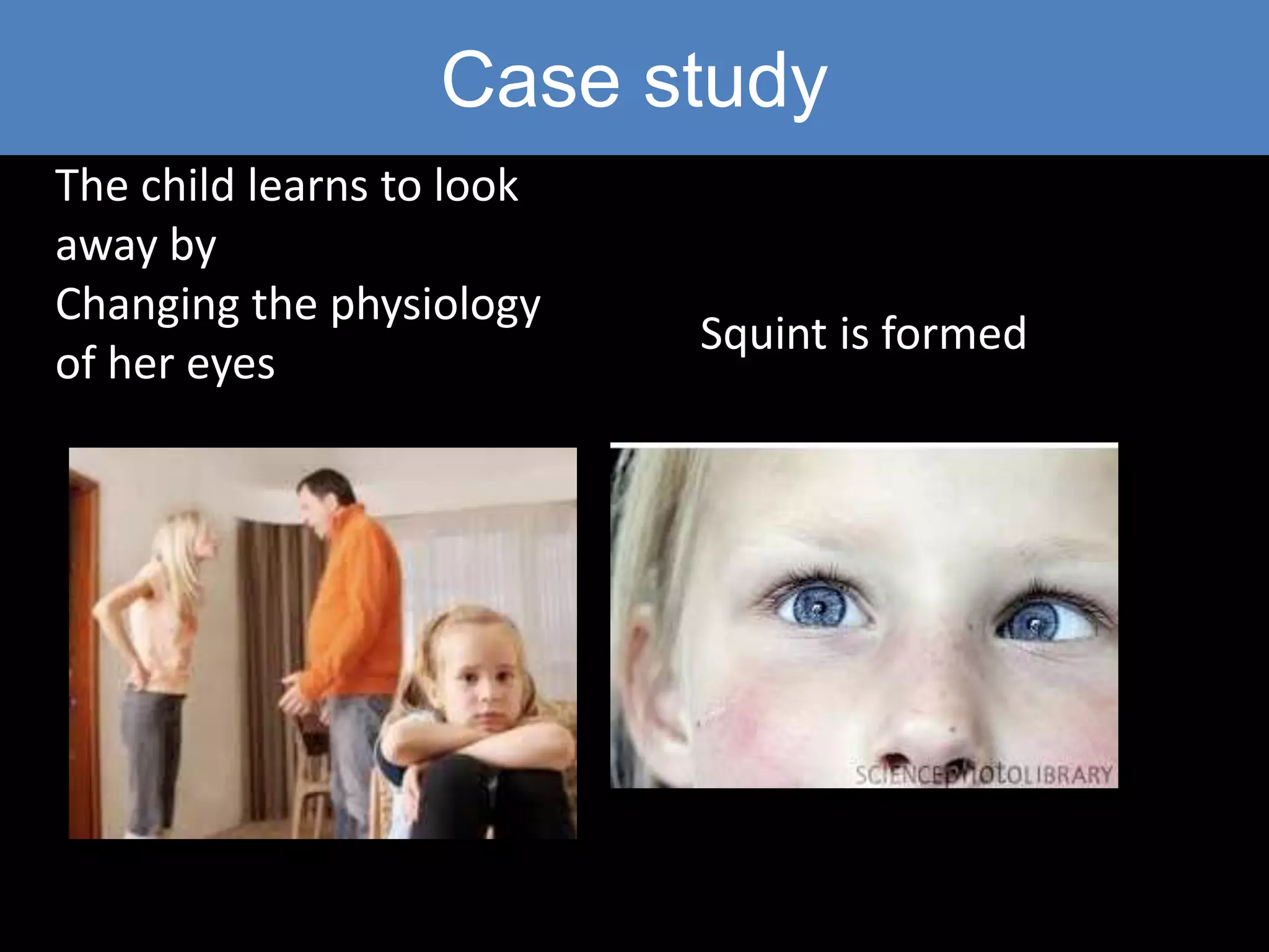 Case study
The child learns to look
away by
Changing the physiology
of her eyes
Squint is formed
 