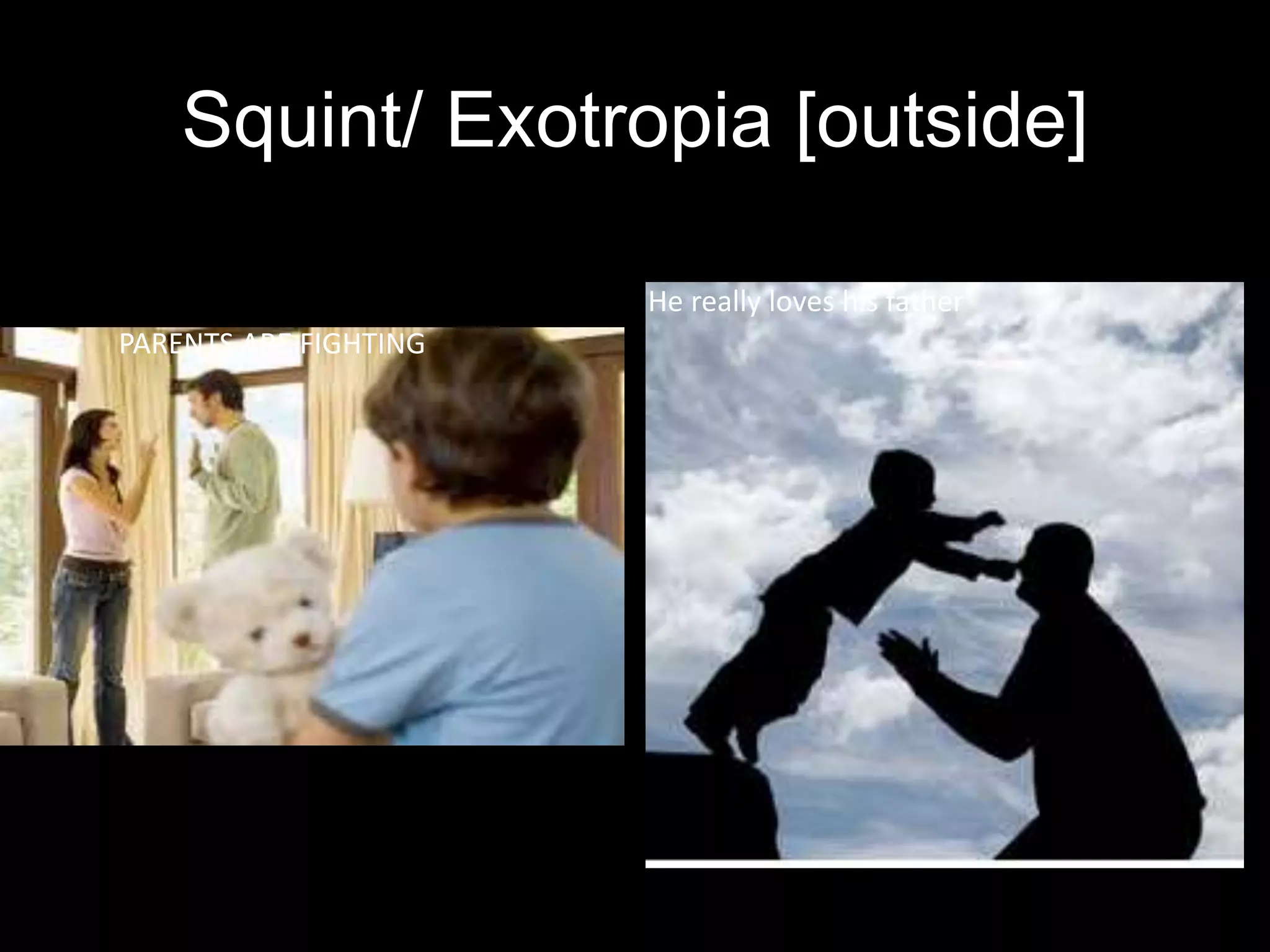 Squint/ Exotropia [outside]
PARENTS ARE FIGHTING
He really loves his father
 