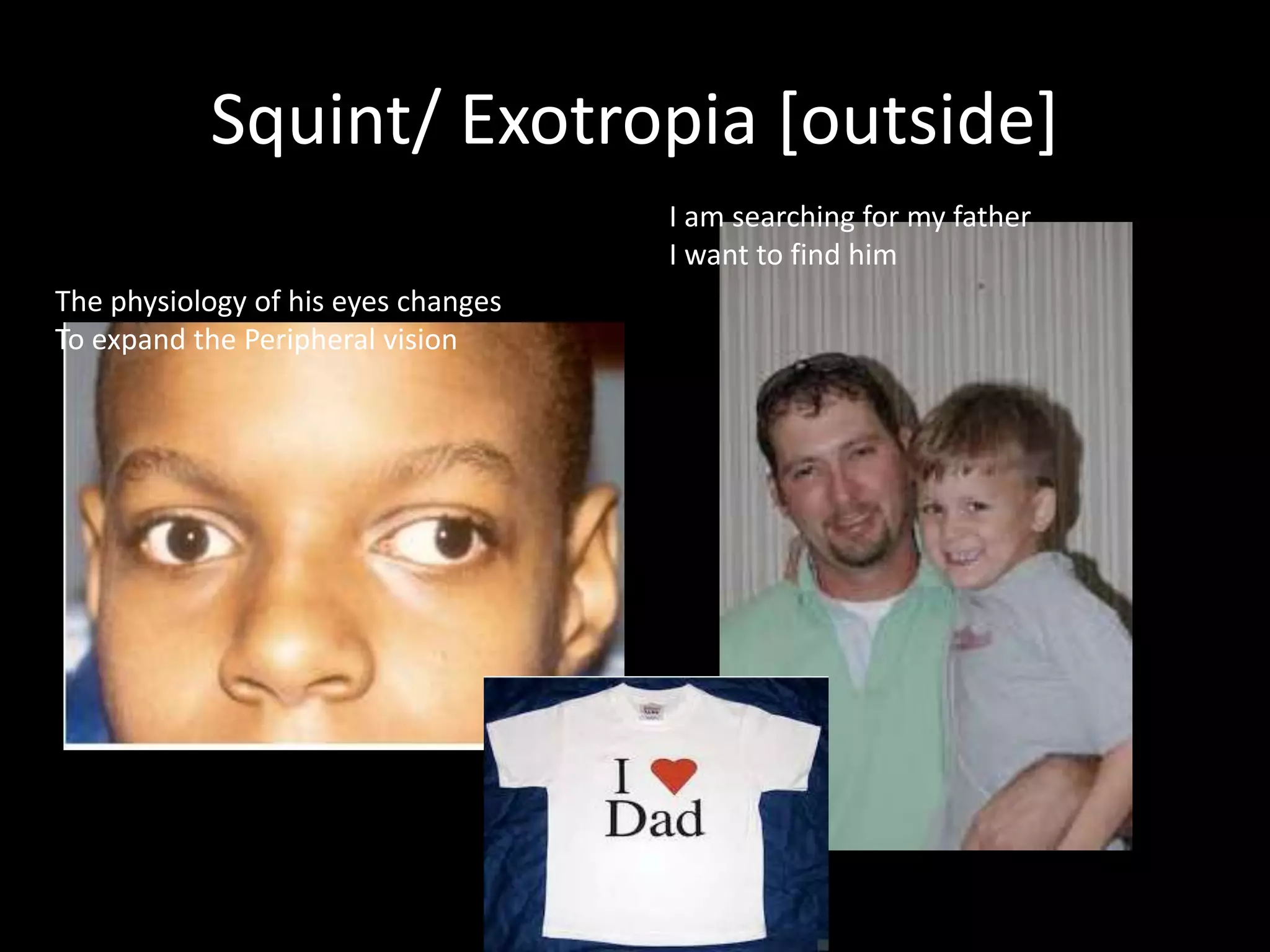 Squint/ Exotropia [outside]
The physiology of his eyes changes
To expand the Peripheral vision
I am searching for my father
I want to find him
 