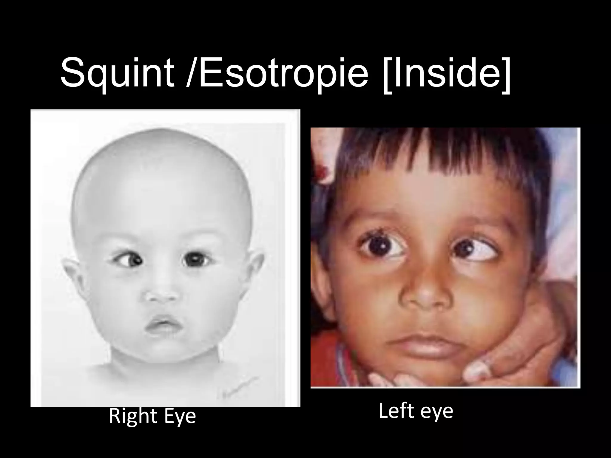 Squint /Esotropie [Inside]
Right Eye Left eye
 