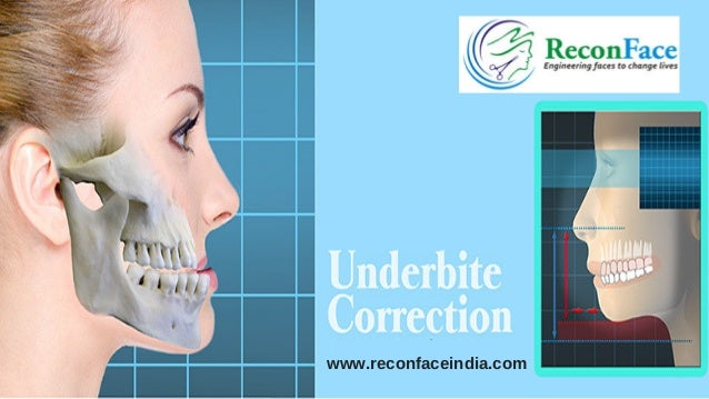 underbite correction in hyderabad jaw surgery in india underbite surgery