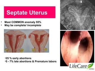 Septate Uterus
• Most COMMON anomaly 55%
• May be complete/ incomplete
•25 % early abortions
•5 - 7% late abortions & Premature labors
 