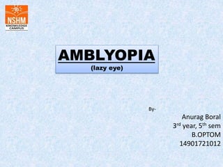 AMBLYOPIA
(lazy eye)
By-
Anurag Boral
3rd year, 5th sem
B.OPTOM
14901721012
 