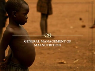 GENERAL MANAGEMENT OF
MALNUTRITION
 