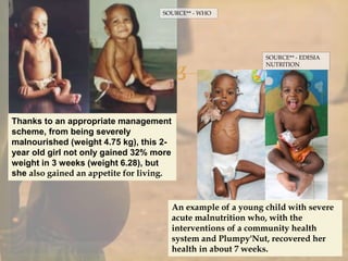 
Thanks to an appropriate management
scheme, from being severely
malnourished (weight 4.75 kg), this 2-
year old girl not only gained 32% more
weight in 3 weeks (weight 6.28), but
she also gained an appetite for living.
SOURCE** - WHO
An example of a young child with severe
acute malnutrition who, with the
interventions of a community health
system and Plumpy'Nut, recovered her
health in about 7 weeks.
SOURCE** - EDESIA
NUTRITION
 