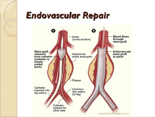 Resection Avf Aneurysm and av fistula