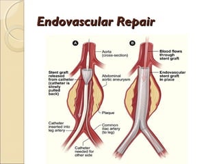 Endovascular RepairEndovascular Repair
 