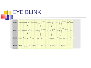 EYE BLINK
 