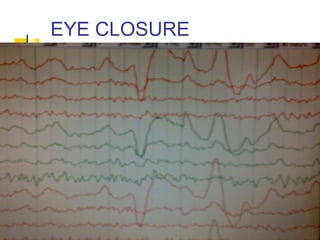 EYE CLOSURE
 
