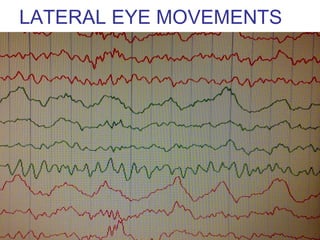 LATERAL EYE MOVEMENTS
 