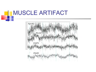 MUSCLE ARTIFACT
 