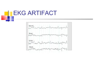 EKG ARTIFACT
 