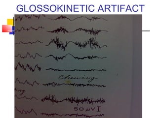 GLOSSOKINETIC ARTIFACT
 