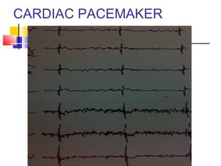 CARDIAC PACEMAKER
 